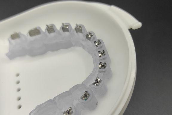 Indirect bonding tray with braces in a box.